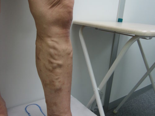 ふくらはぎの静脈瘤