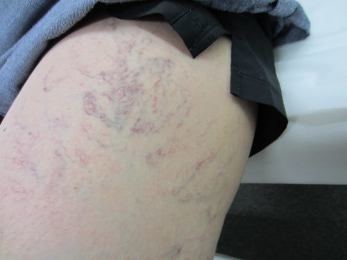 クモの巣静脈瘤