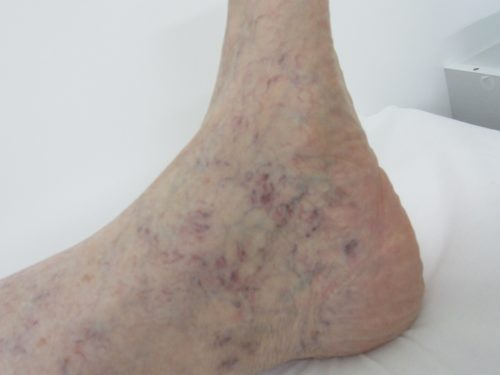 足首の浮き出た血管２