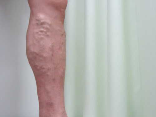 ふくらはぎの静脈瘤