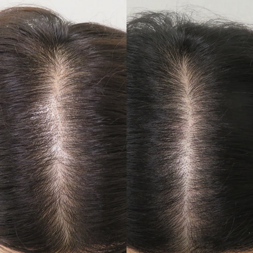 施術名：w-スカルプ／施術の説明：ご自身の血液から抽出した成長因子を頭皮へダイレクトに注入することで、発毛サイクルを正常化し毛髪再生を促進する治療です。／副作用・リスク：効果の個人差、赤み、内出血、アレルギー反応、かぶれ